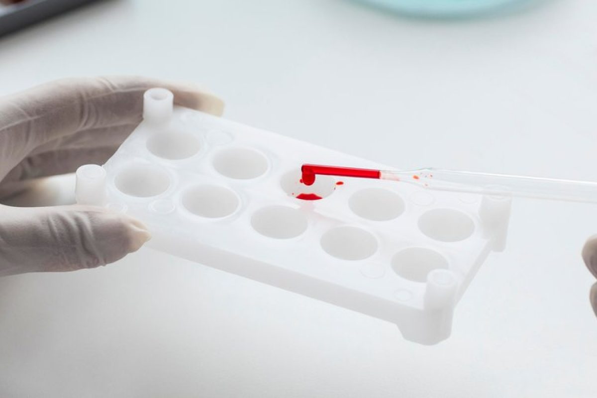 absence-immunoglobuline-monoclonale