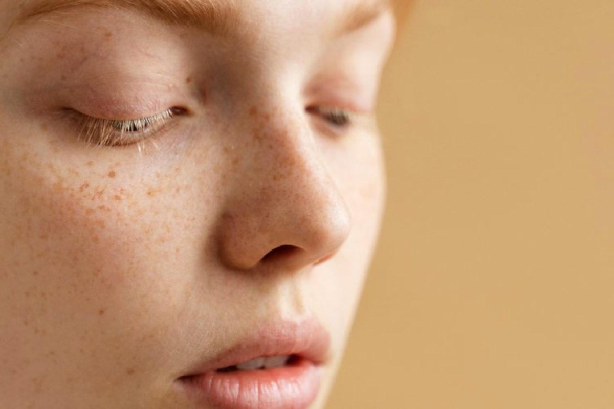 taches-pigmentaires-causes-prevention-naturelle